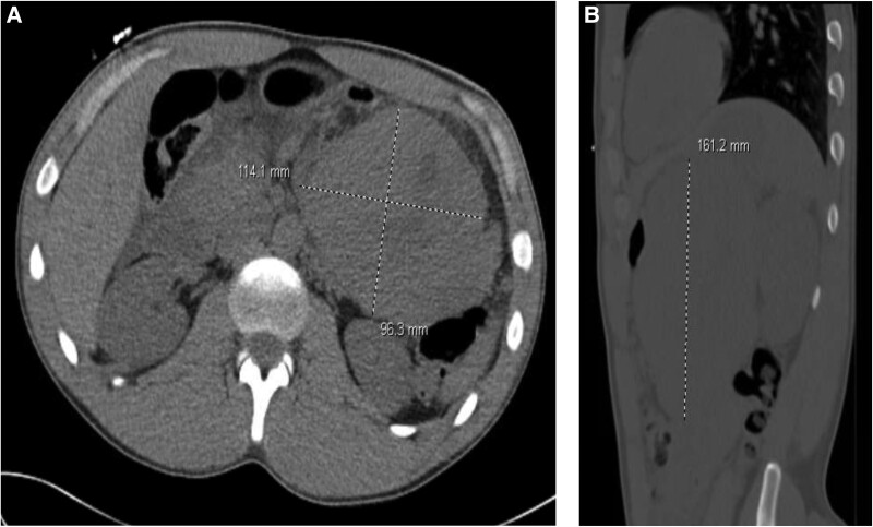 Severe, Symptomatic Hypercalcemia Secondary to PTH-secreting Pancreatoblastoma.
