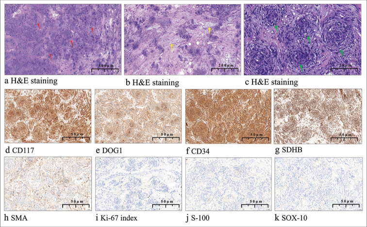 Gastrointestinal stromal tumor mimicking perineurioma: A case report.