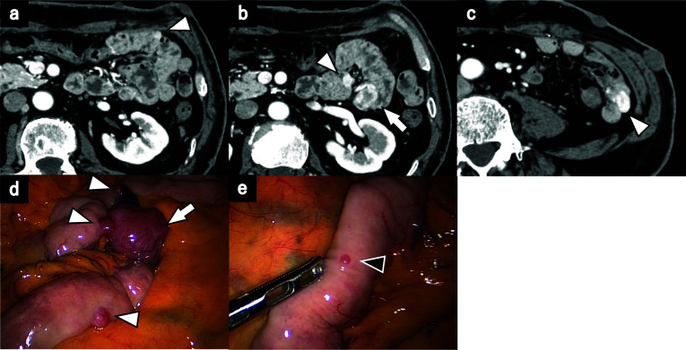 Appendiceal neurofibroma after resection of multiple gastrointestinal stromal tumors of the small intestine in a patient with neurofibromatosis type 1: a case report.