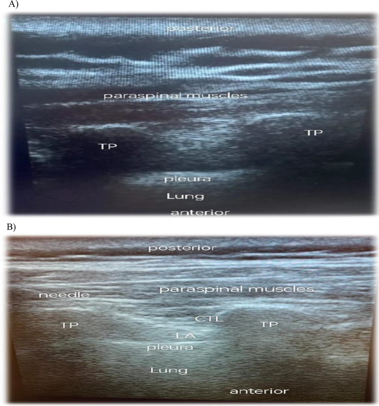Comparison between ultrasound guided erector spinae plane block and paravertebral block on acute and chronic post mastectomy pain after modified radical mastectomy: randomized controlled trial.
