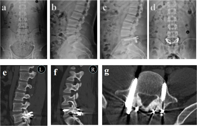 Evaluation of V-type titanium cable internal fixation for the treatment of young adult fifth lumbar spondylolysis: technical notes and a retrospective clinical study.