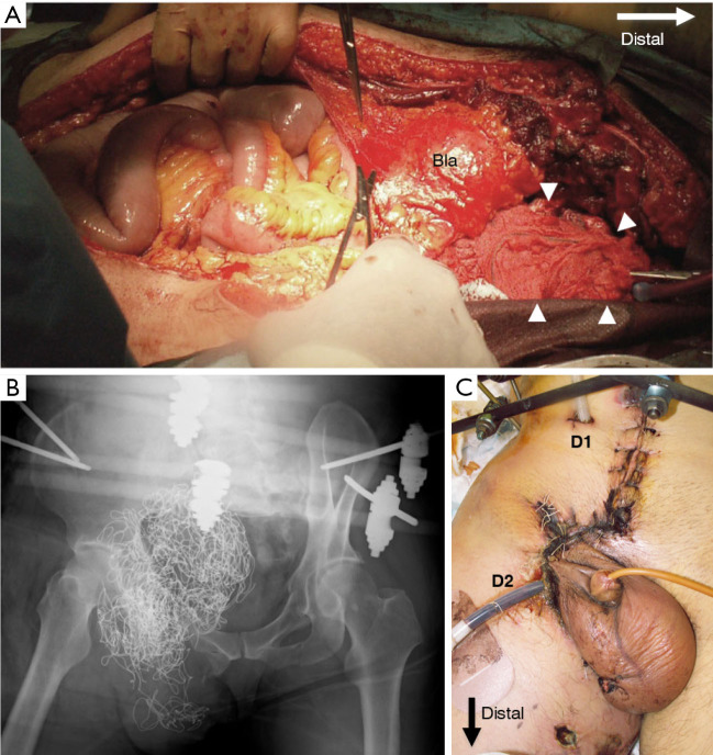 Polymicrobial infection presenting as non-clostridial gas gangrene in a patient with an open pelvic ring fracture accompanied by abdominal evisceration: a case report.
