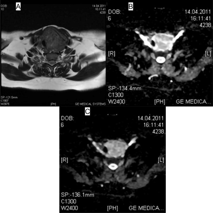 Effectiveness of diffusion-weighted magnetic resonance imaging (DW-MRI) in the differentiation of thyroid nodules.