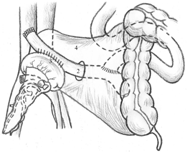 Retroperitoneal pancreas transplantation with a Roux-en-Y duodenojejunostomy for exocrine drainage.
