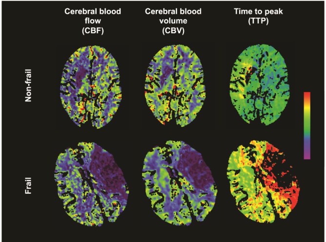 Frailty reduces penumbral volumes and attenuates treatment response in hyperacute ischemic stroke.