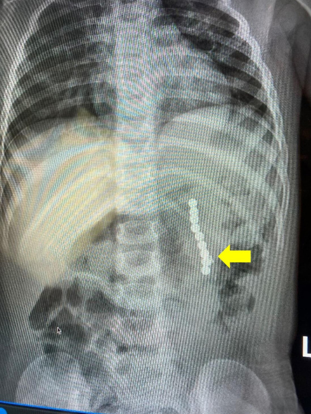 Ingested Magnets Found Inadvertently During Elective Magnetic Resonance Imaging.