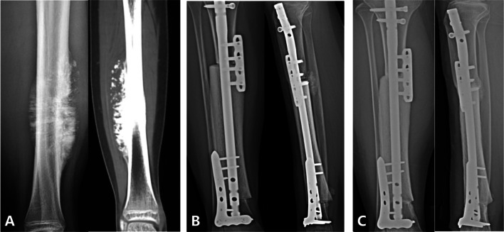 Comparison of survival, function and complication between intercalary frozen autograft versus massive allograft reconstruction after malignant bone tumors resection.