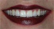 Community Water Fluoridation a Cost-Benefit-Risk Consideration.