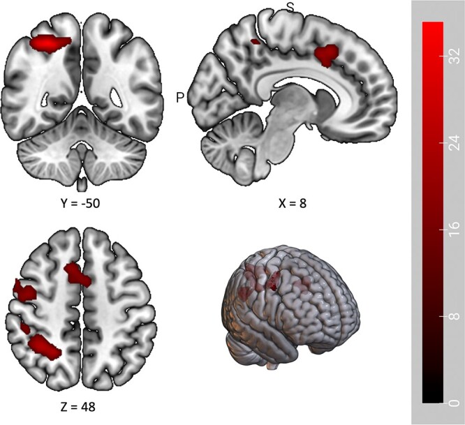 Comparative effects of topiramate and naltrexone on neural activity during anticipatory anxiety in individuals with alcohol use disorder.