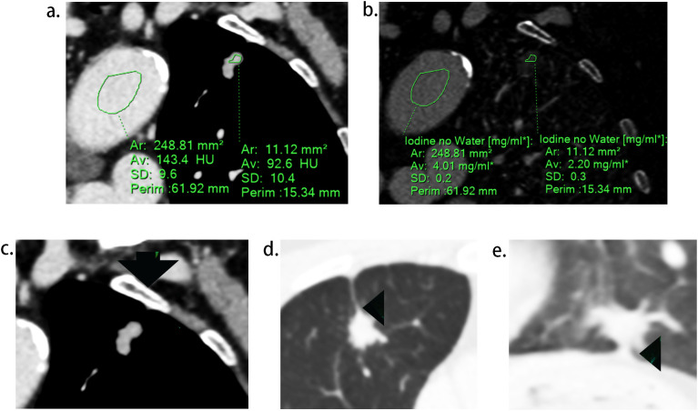 Using the length of pleural tag to predetermine pleural invasion by lung adenocarcinomas.