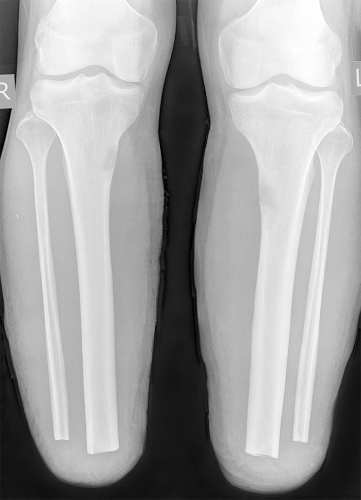 Bilateral Stress Fractures of Amputated Tibial Stumps in the Setting of Chronic Compartment Syndrome.