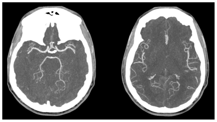 Acute Border Zone Infarcts in Hypereosinophilic Syndrome.