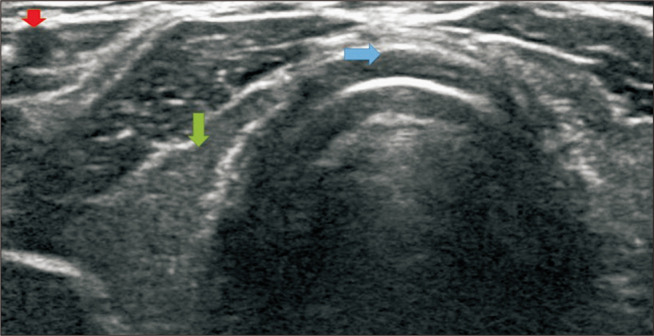 Ultrasound-Guided Percutaneous Tracheostomy in Cardiovascular and Thoracic Surgery of South Korea: Retrospective Evaluation of Efficacy and Safety in Critically Ill Patients.
