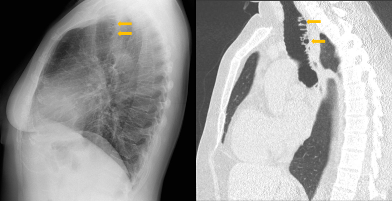 Tracheobronchial Diverticulosis.