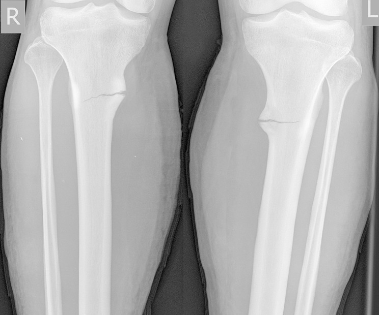 Bilateral Stress Fractures of Amputated Tibial Stumps in the Setting of Chronic Compartment Syndrome.