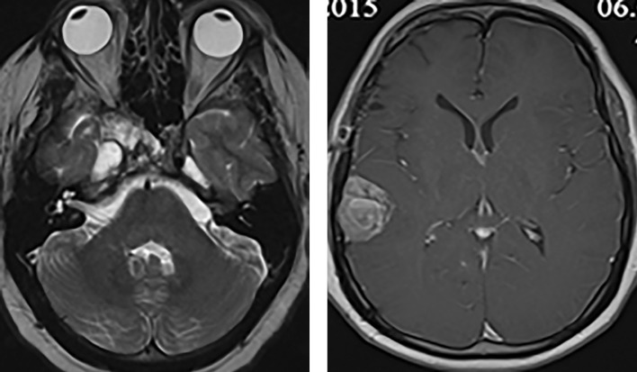 [Efficacy of standard methods in the treatment of prolactin-secreting pituitary carcinoma].