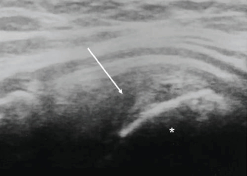 Rotator Cuff Tears and Mid-Term Shoulder Outcomes after Intramedullary Nail Fixation for Humeral Shaft Fracture: A Minimum Five-year Follow-up Study.
