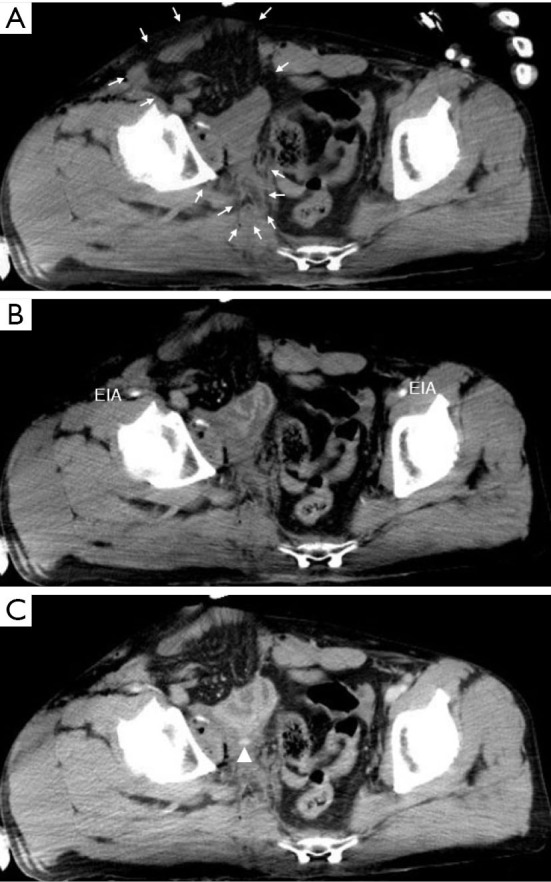 Polymicrobial infection presenting as non-clostridial gas gangrene in a patient with an open pelvic ring fracture accompanied by abdominal evisceration: a case report.
