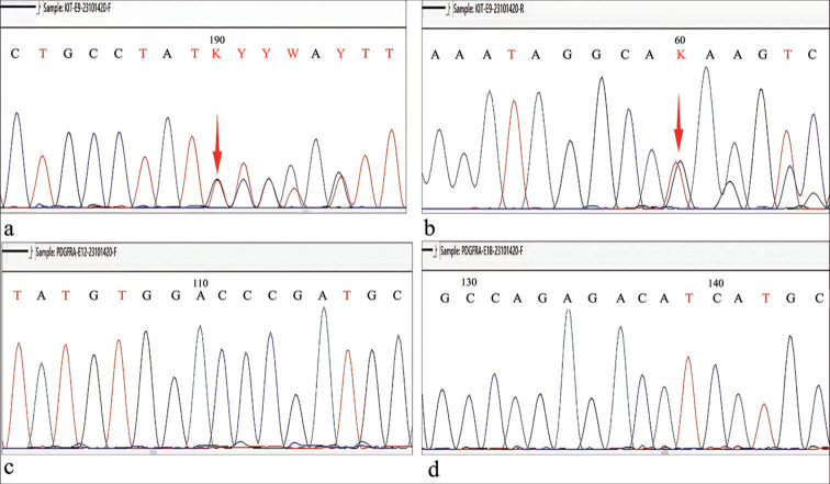 Gastrointestinal stromal tumor mimicking perineurioma: A case report.