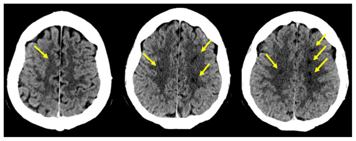 Acute Border Zone Infarcts in Hypereosinophilic Syndrome.
