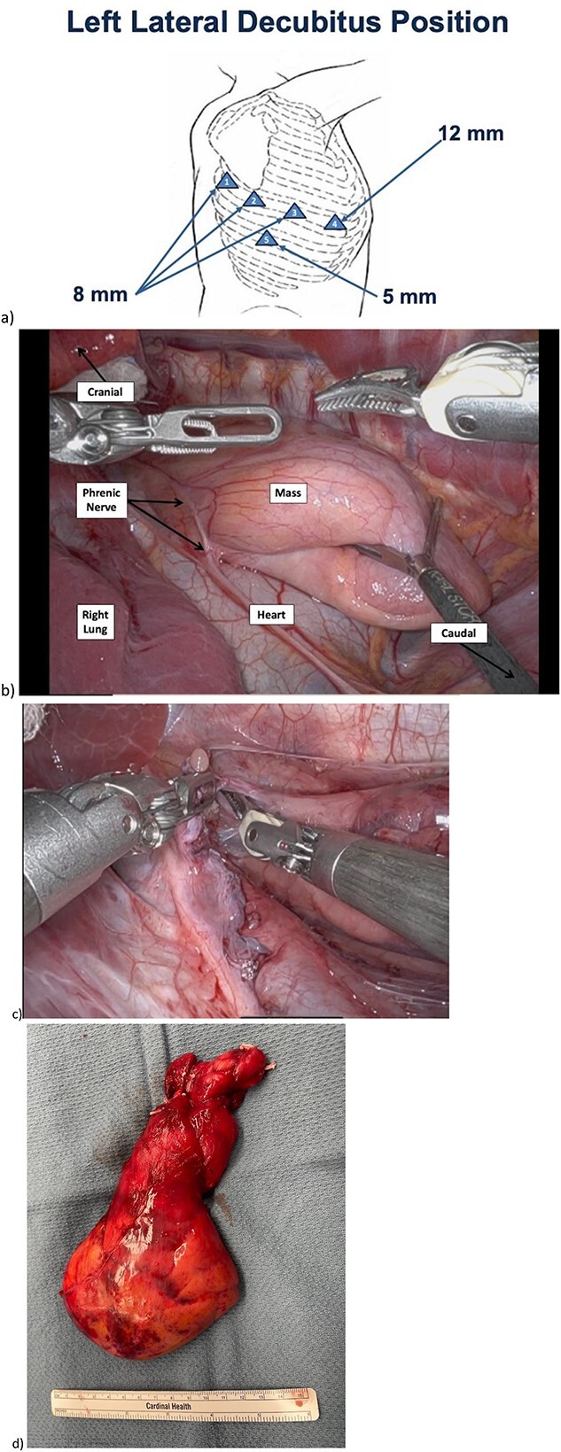 Robotic resection of a giant thymolipoma in a pediatric patient.
