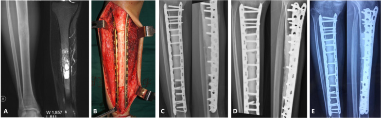 Comparison of survival, function and complication between intercalary frozen autograft versus massive allograft reconstruction after malignant bone tumors resection.