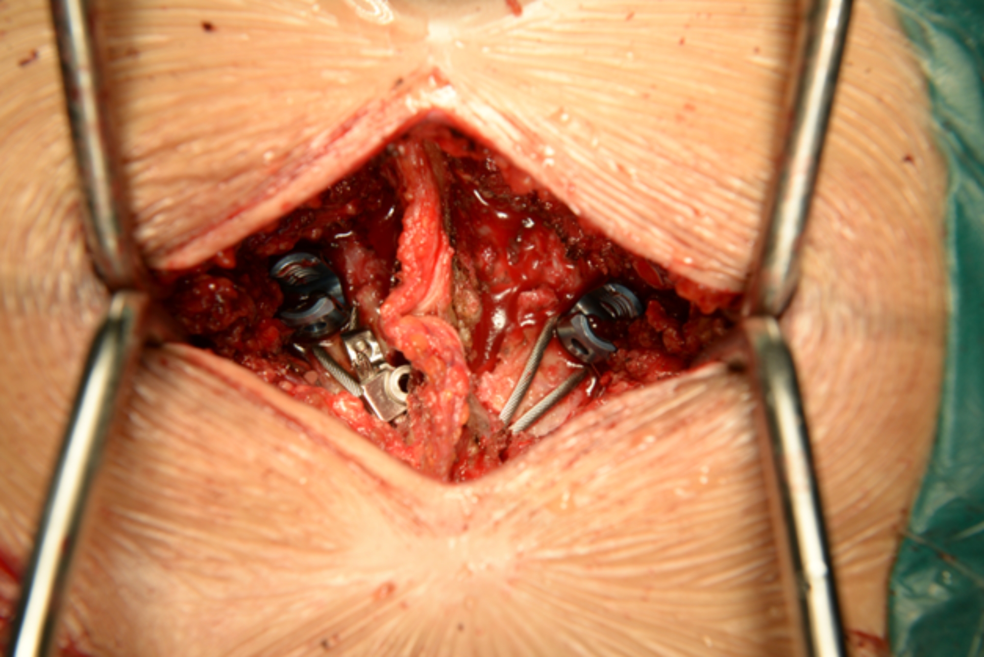 Evaluation of V-type titanium cable internal fixation for the treatment of young adult fifth lumbar spondylolysis: technical notes and a retrospective clinical study.