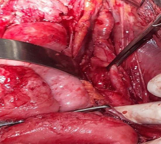 Appendicular Ureteroplasty for a Firearm Related Rupture of the Right Ureter.
