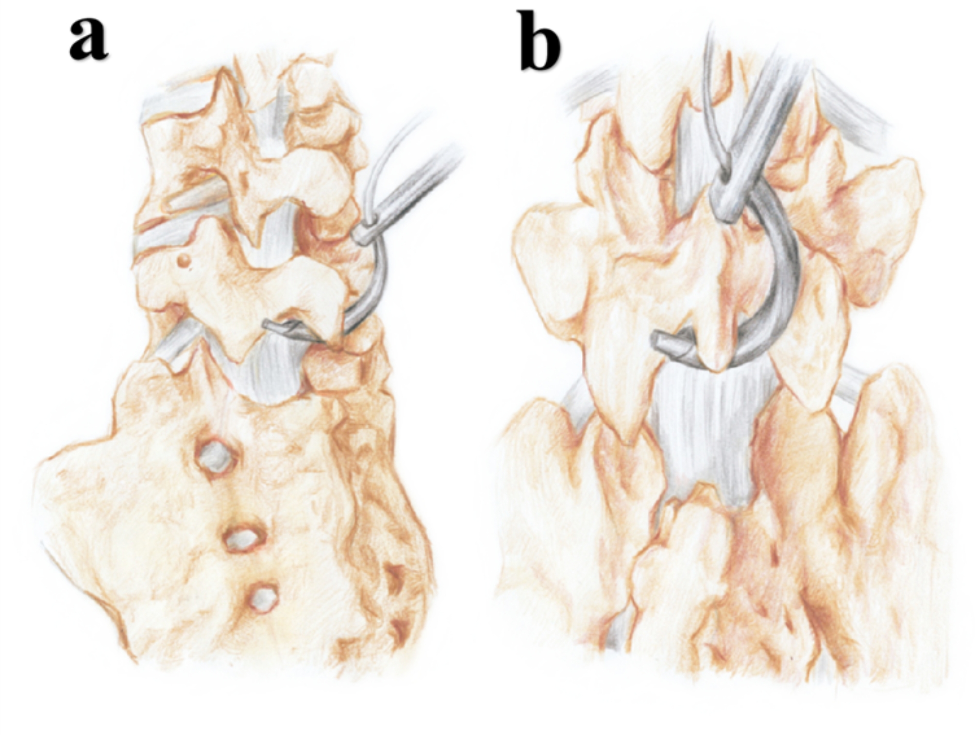 Evaluation of V-type titanium cable internal fixation for the treatment of young adult fifth lumbar spondylolysis: technical notes and a retrospective clinical study.