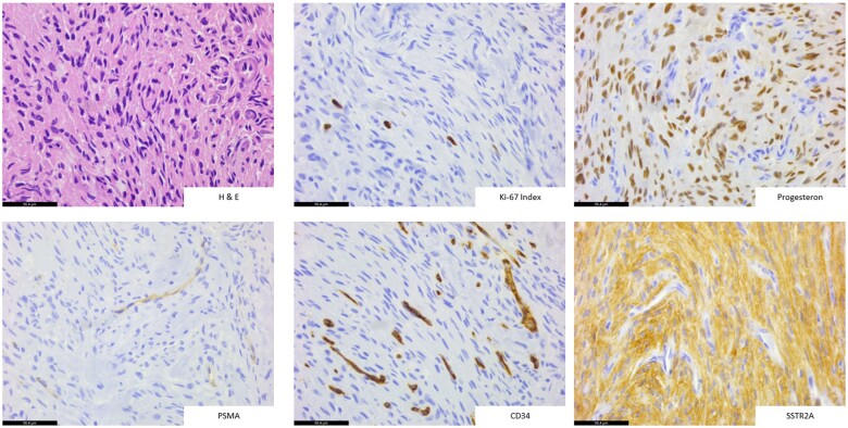 A challenging discrimination of an intensely [<sup>18</sup>F]PSMA-1007-avid solitary lesion at the skull base in a patient with biochemical recurrence of prostate cancer.