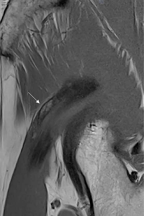 Heterotopic Ossification of the Indirect Head of the Rectus Femoris.