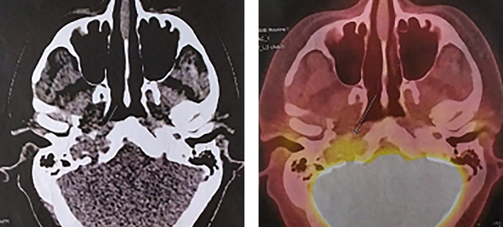 [Efficacy of standard methods in the treatment of prolactin-secreting pituitary carcinoma].