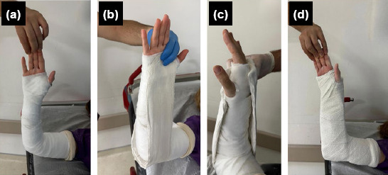 Radiological comparison of two immobilization methods in the non-surgical treatment of distal radius fractures in the elderly: Single sugar-tong splint shows similar efficacy to long-arm cast.
