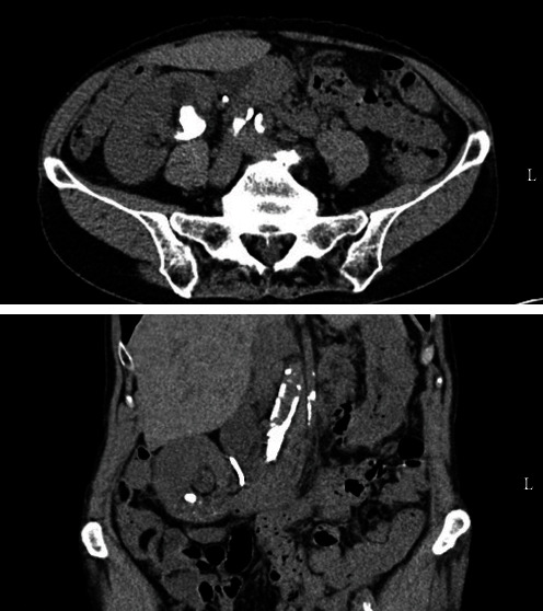 A Rare Cause of Colon Perforation After Percutaneous Nephrolithotomy-A Case Report and Review of the Literature.