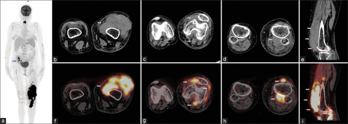 Isolated Muscular NK/T Cell Lymphoma: A Rare Presentation of Post-Transplant Lymphoproliferative Disorders.
