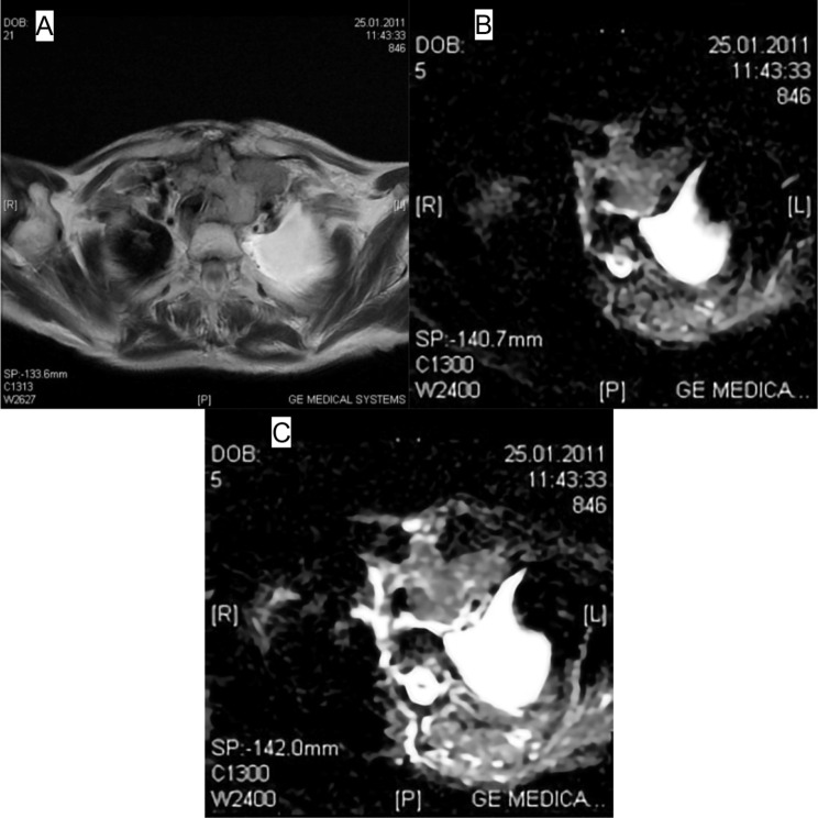 Effectiveness of diffusion-weighted magnetic resonance imaging (DW-MRI) in the differentiation of thyroid nodules.