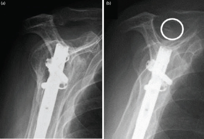 Rotator Cuff Tears and Mid-Term Shoulder Outcomes after Intramedullary Nail Fixation for Humeral Shaft Fracture: A Minimum Five-year Follow-up Study.