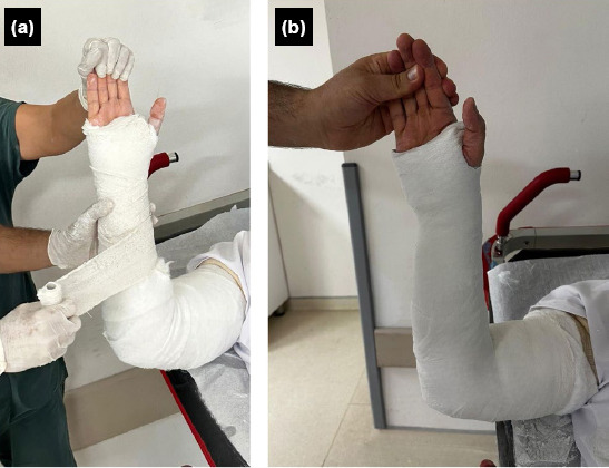 Radiological comparison of two immobilization methods in the non-surgical treatment of distal radius fractures in the elderly: Single sugar-tong splint shows similar efficacy to long-arm cast.