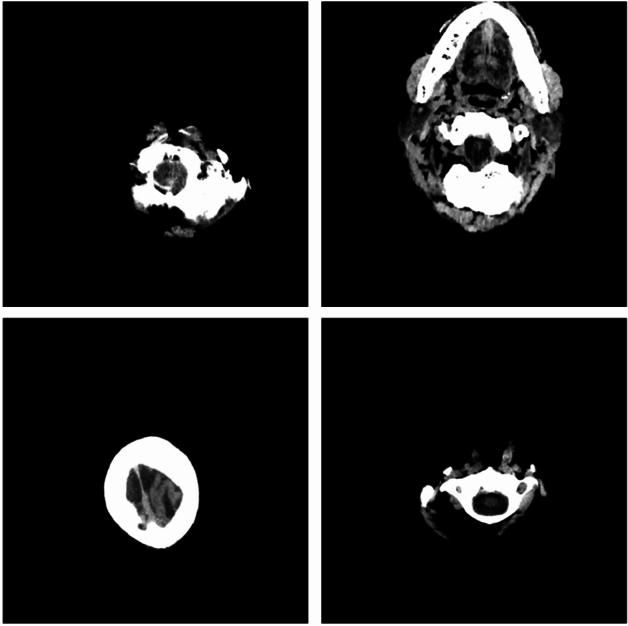 Dual-task vision transformer for rapid and accurate intracerebral hemorrhage CT image classification.