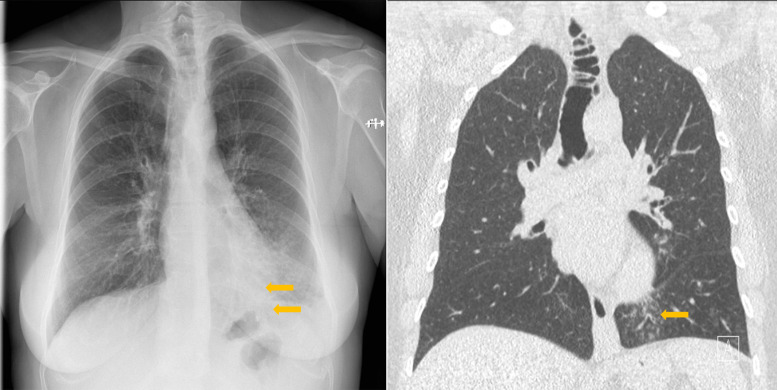 Tracheobronchial Diverticulosis.