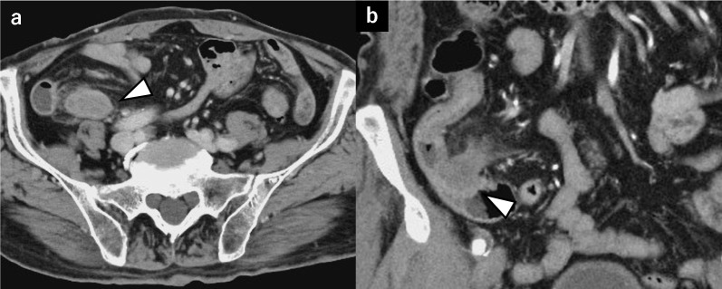 Appendiceal neurofibroma after resection of multiple gastrointestinal stromal tumors of the small intestine in a patient with neurofibromatosis type 1: a case report.