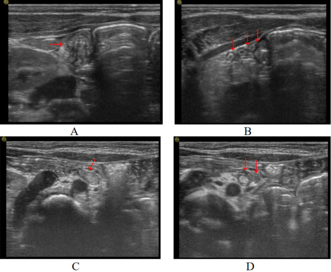 Ultrasonographic characteristics of neonatal appendicitis: a case series.