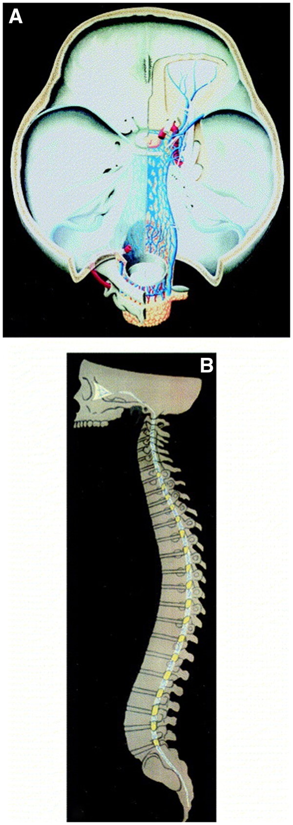 A challenging discrimination of an intensely [<sup>18</sup>F]PSMA-1007-avid solitary lesion at the skull base in a patient with biochemical recurrence of prostate cancer.
