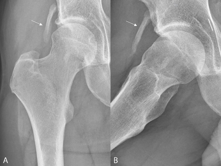 Heterotopic Ossification of the Indirect Head of the Rectus Femoris.