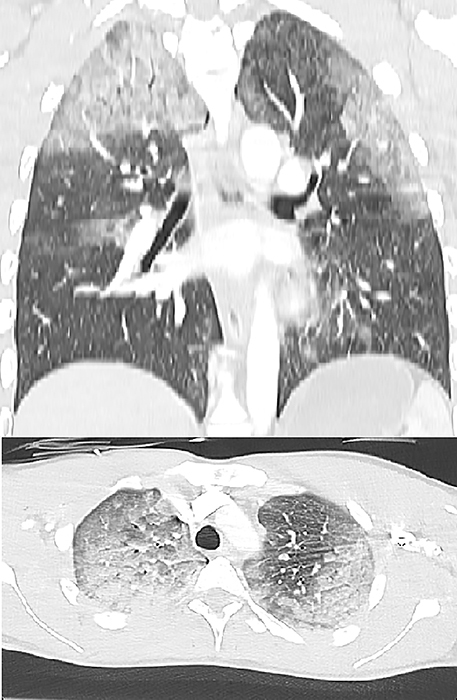 Neurogenic Pulmonary Edema in a Patient with Traumatic Brain Injury.