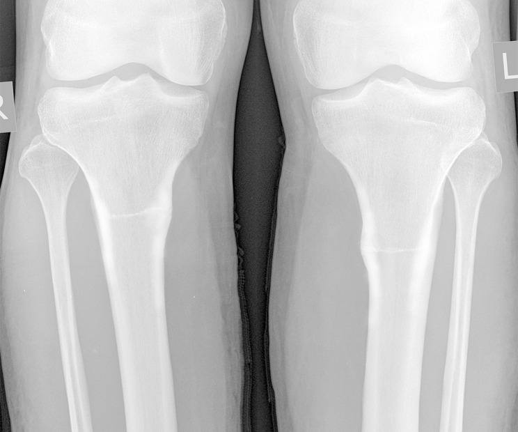 Bilateral Stress Fractures of Amputated Tibial Stumps in the Setting of Chronic Compartment Syndrome.