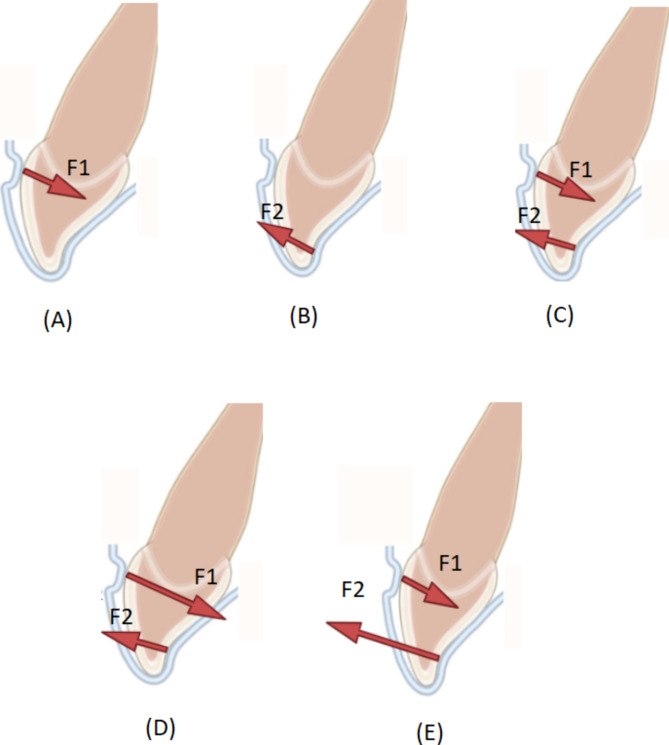 Seeking orderness out of the orderless movements: an up-to-date review of the biomechanics in clear aligners.