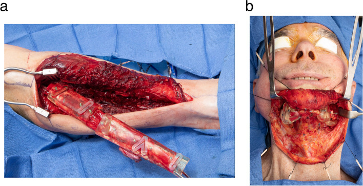 Stratifying complexity among the widespread use of 3D printing in United States health care facilities.