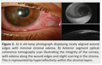 Anterior Segment Optical Coherence Tomography-Assisted Surgical Planning for Removal of a Corneal Foreign Body: A Case Report and Literature Review.