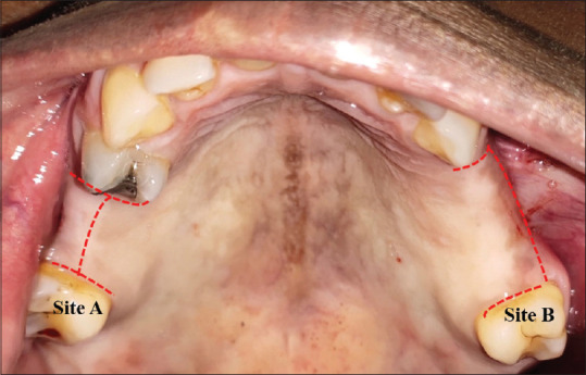Subcrestal incision: An alternative flap design for dental implant placement - A randomized controlled split-mouth design clinical trial.